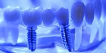 Discover the Difference Between Dental Implants & Dentures at Hulse Dental